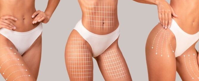 bodysculpting accufit treatment