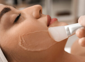 chemical peel procedure