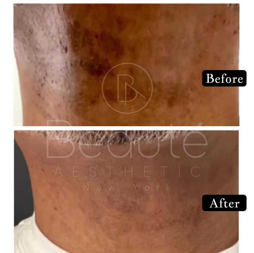 Morpheus8 Before and After