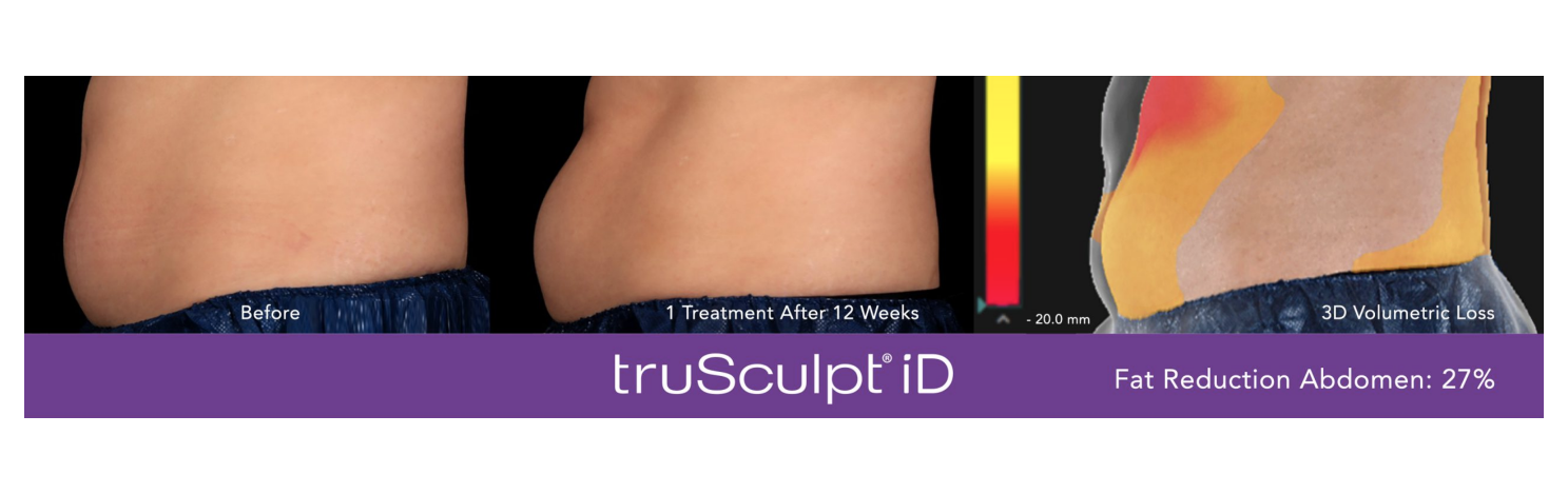 TRUSCUPLT iD before after