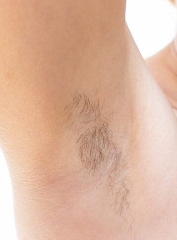 Woman underarms, armpit before and after depilation, laser waxing and sugaring