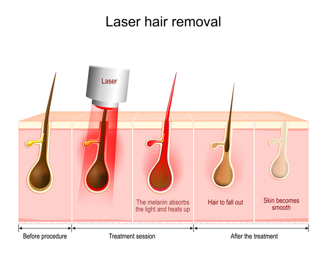 best laser hair removal naer me