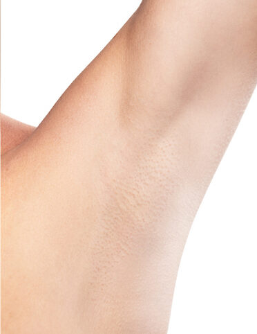 Comparison of female armpit after hair removal