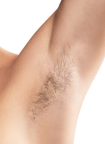 laser hair removal before