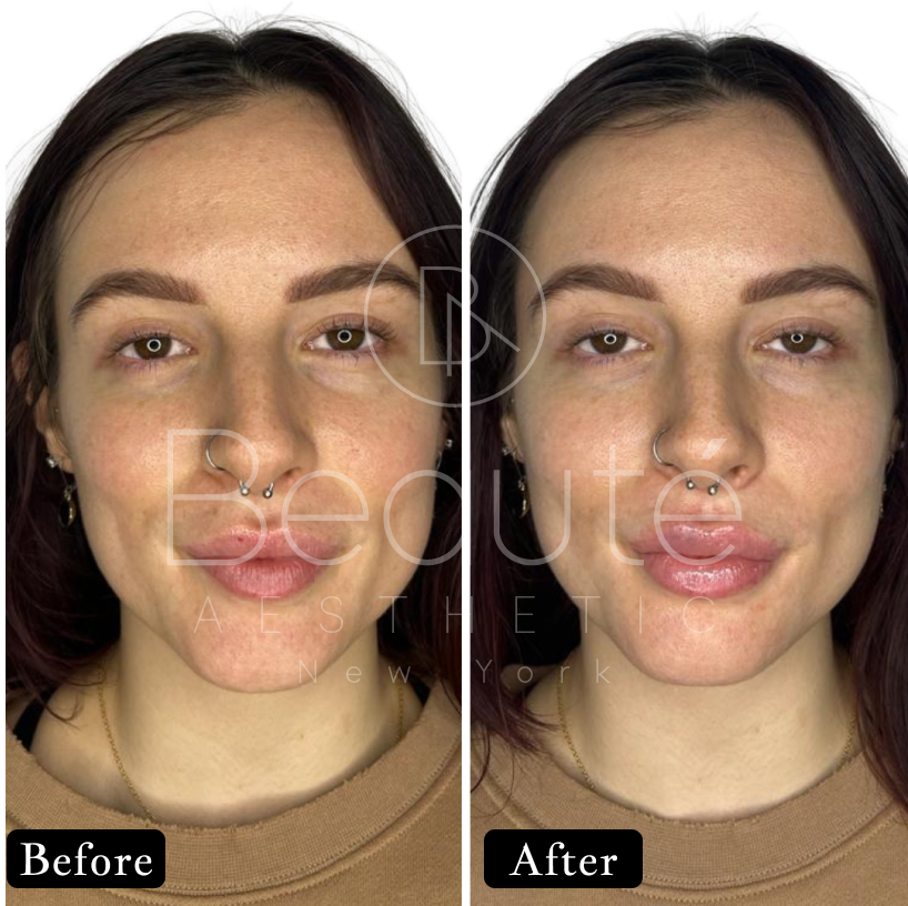 lip filler before and after