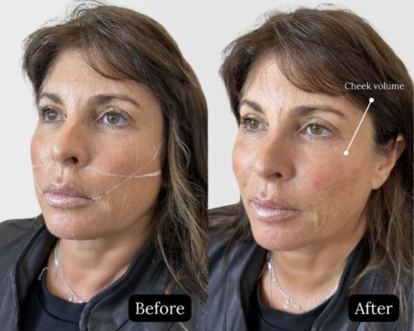 Cheek fillers before and after
