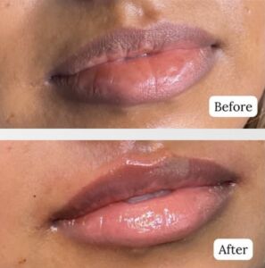 Lip filler before and after (1) Lip filler before and after