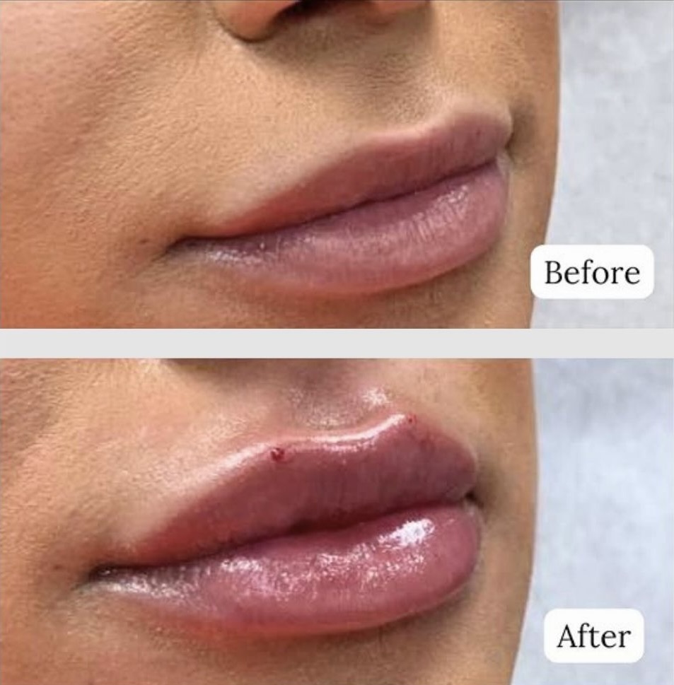 Lip filler before and after Lip filler before and after