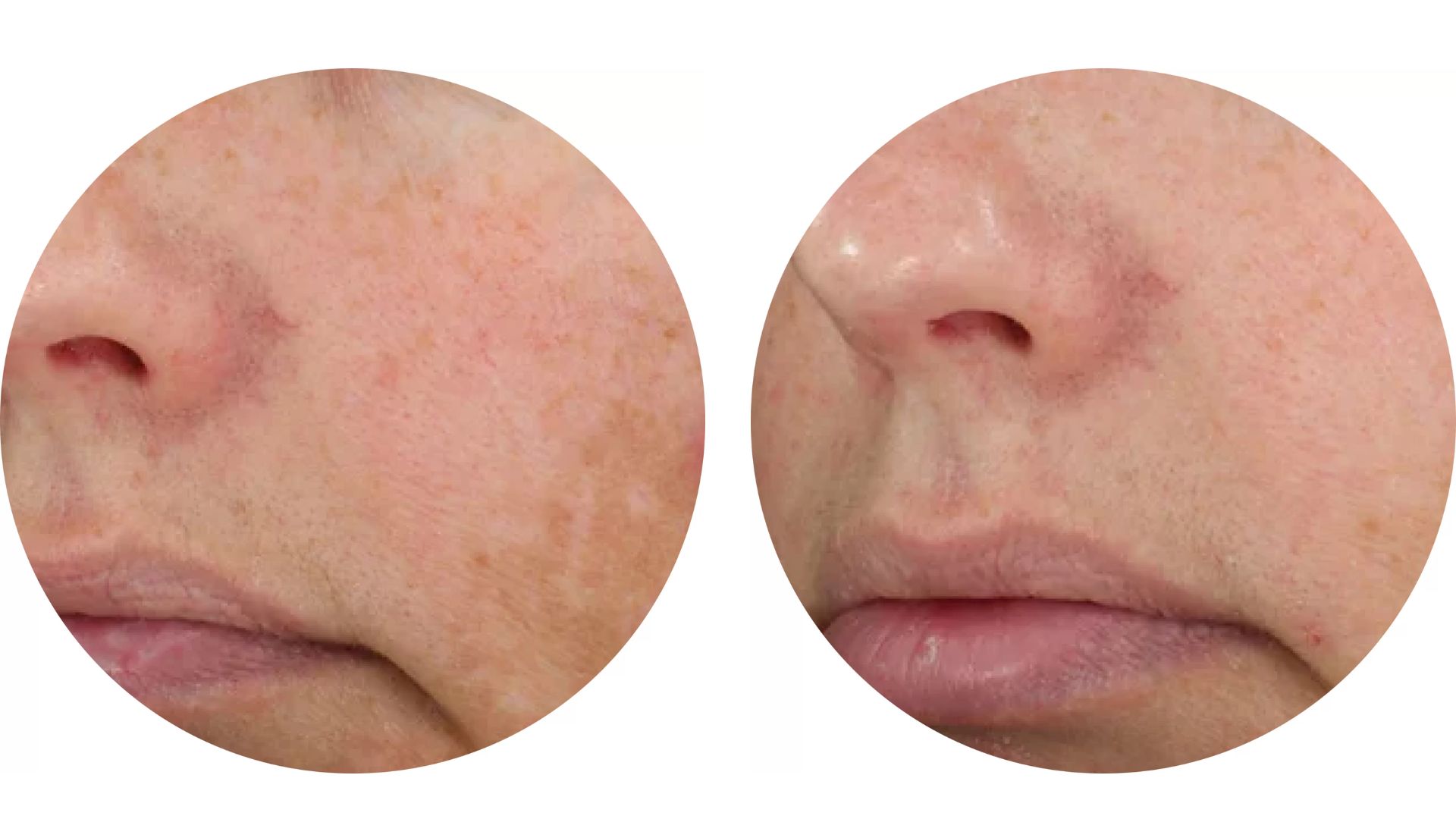 Diamond glow before and after