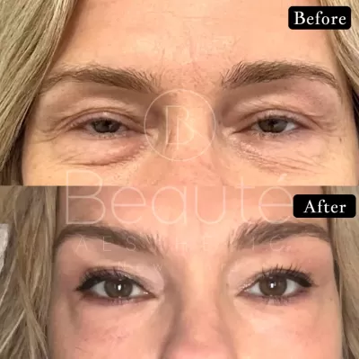 Morpheus8 under eyes before & after