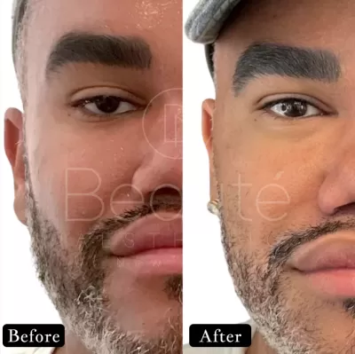 Morpheus8 face before & after 