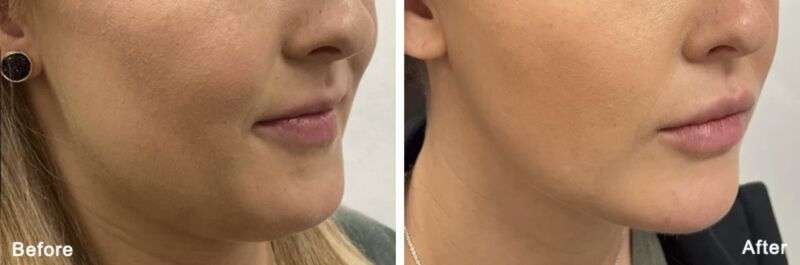 Morpheus8 double chin before & after