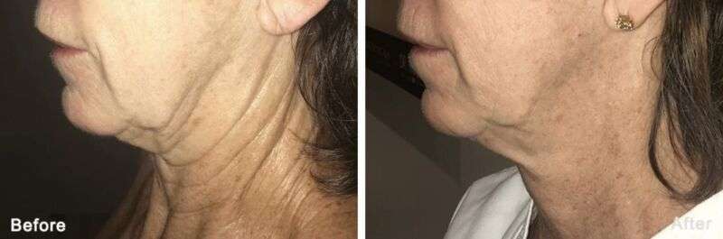Morpheus8 Neck before & after