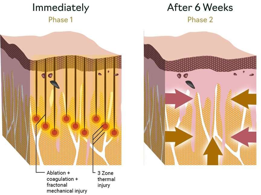 Morpheus8 skin healing phases