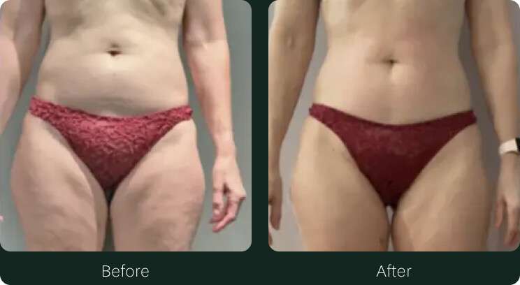 Before & After body sculpting