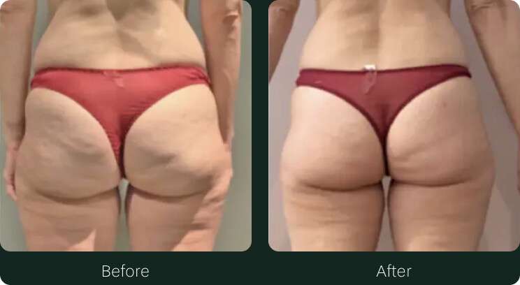 Before & After body sculpting
