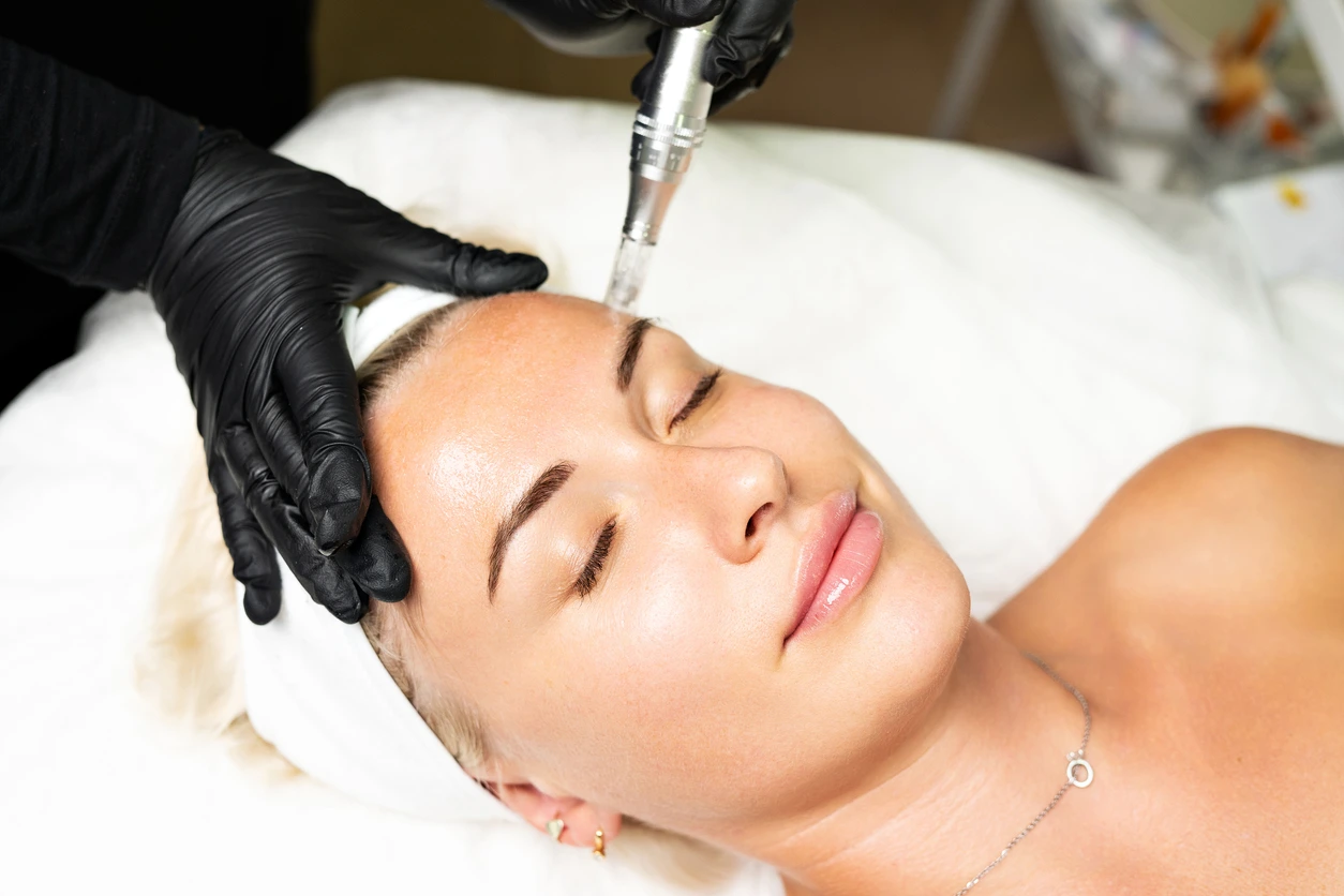 Microneedling Meets Radiofrequency Energy Microneedling-Meets-Radiofrequency-Energy